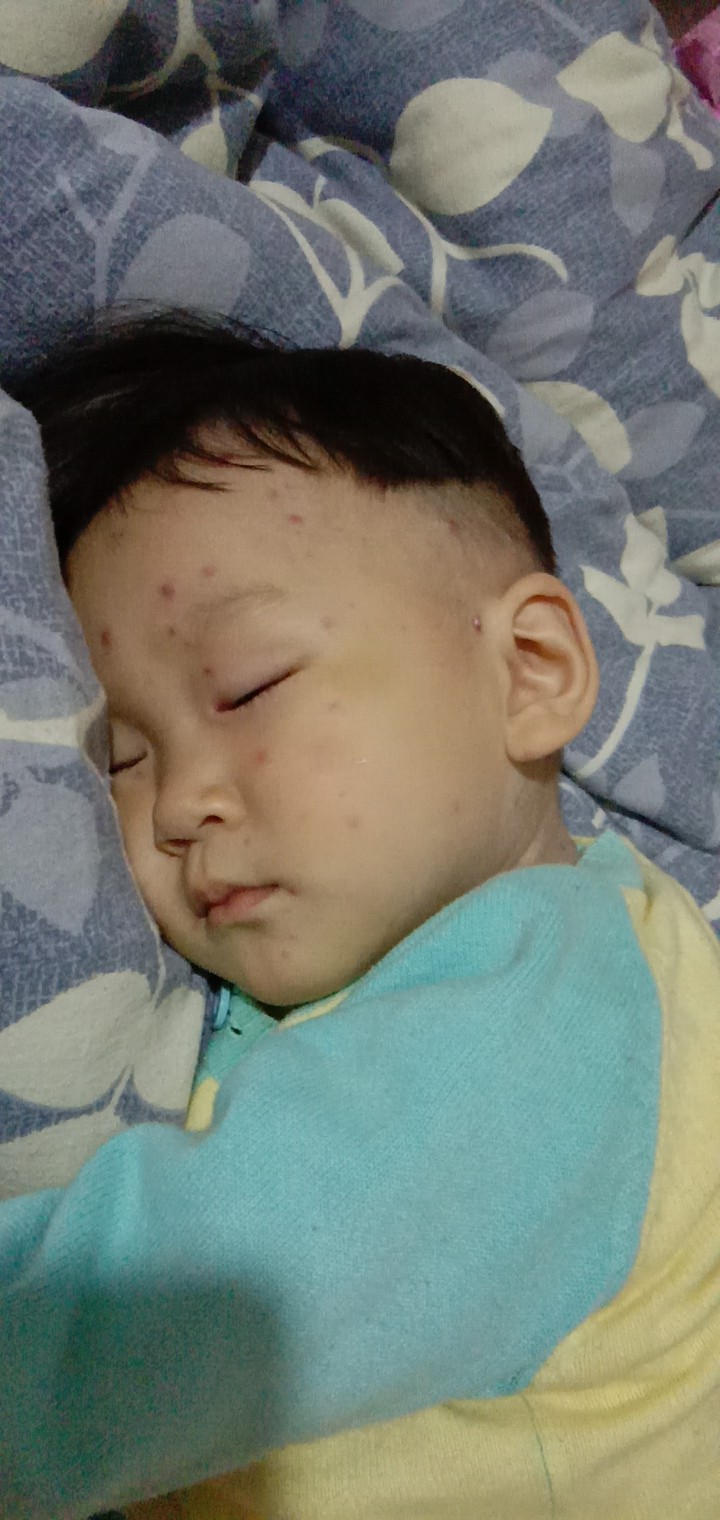 孩子长水痘了怎么办可以上学吗,孩子长水痘会传给大人吗