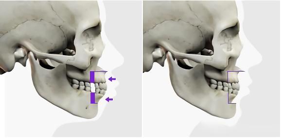 哪些小动作可以改善凸嘴,改善凸嘴的十大方法
