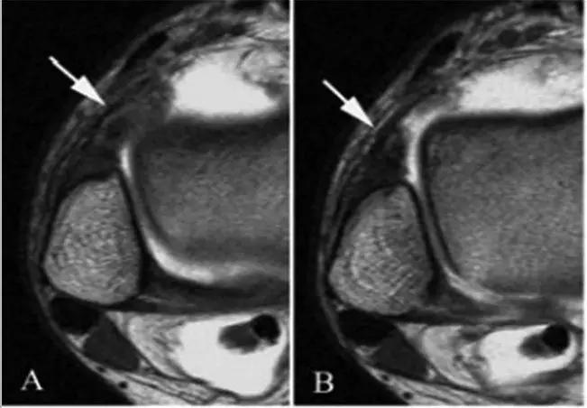 踝关节撞击症问诊,踝关节内侧撞击综合症位置图