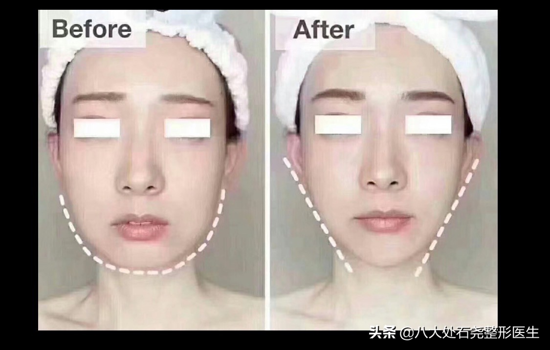 瘦脸针后苹果肌下垂凹陷能恢复吗,你有脸部下垂的烦恼吗