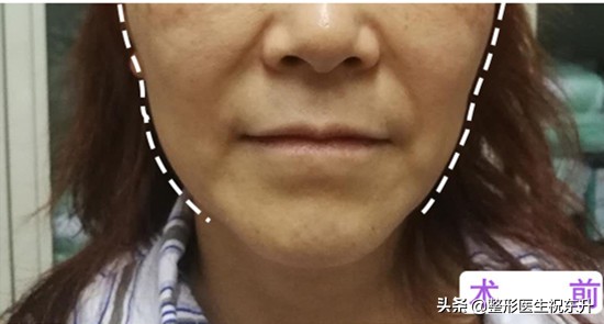 法令纹严重怎么办30岁,中年人怎么去除法令纹