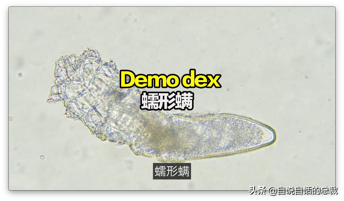 毛囊异型,毛囊里的异形物