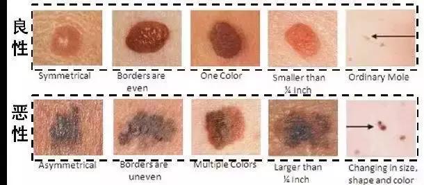 黑痣要去掉吗?专家和你聊聊关于“黑痣”的那些事儿