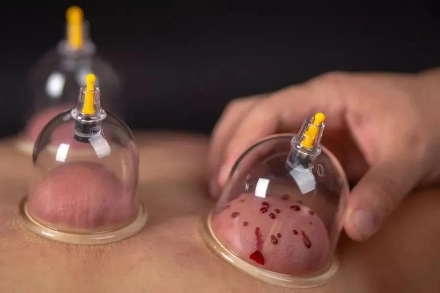 针灸治疗的效果令国外惊叹视频,贺氏三通针灸视频教程