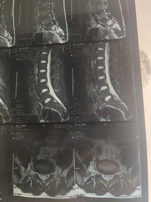 腰突导致肌肉萎缩怎么锻炼比较快,锻炼过度导致腰肌劳损