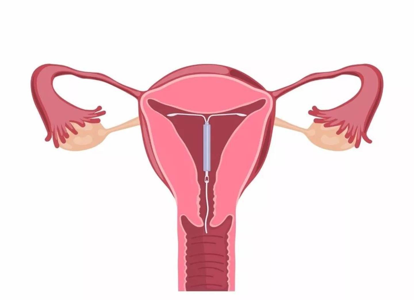 宝宝戴着节育器出生,命中注定的宝宝