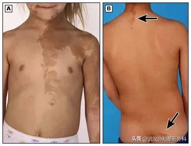 咖啡牛奶斑一定是神经纤维瘤吗,咖啡牛奶斑会突然出现吗