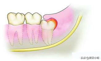 智齿经常疼痛到底要不要拔掉,智齿反复疼痛到底要不要拔掉