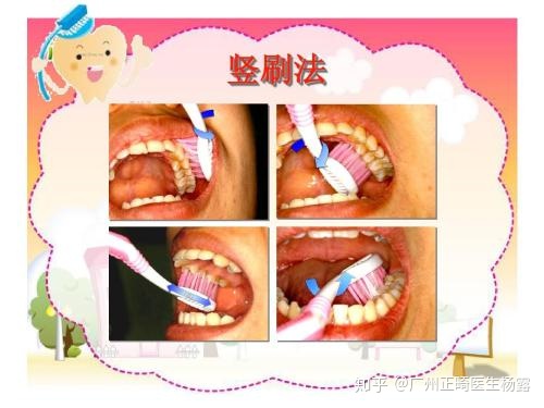 广州隐适美：整牙过程中如何维护口腔卫生