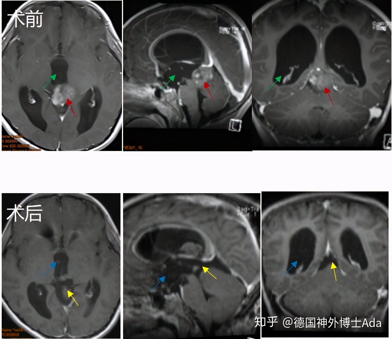 松果区恶性肿瘤能治好吗,松果体区肿瘤大多数是什么样的瘤