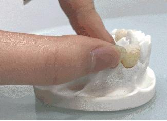 缺一颗上牙在边上镶活牙行吗,单颗牙缺失一个月不补可以吗