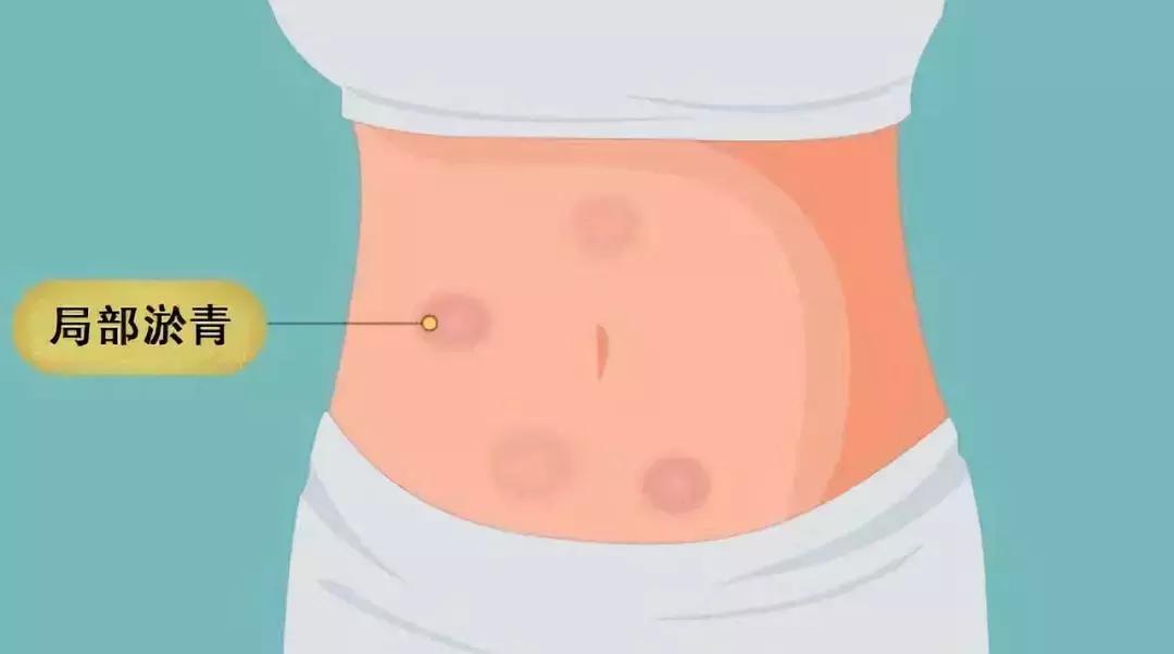 胰岛素注射部位红肿硬化怎么办,打胰岛素肚皮有硬结淤青怎么回事