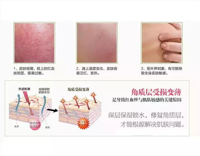 角质层薄容易过敏,角质层薄适合的水