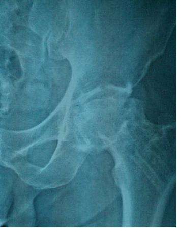 儿童股骨头坏死属于什么科,股骨头缺血性坏死一期应注意什么