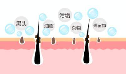 怎么样去黑头最有效最方便的,挤黑头留下的痘坑怎么消除