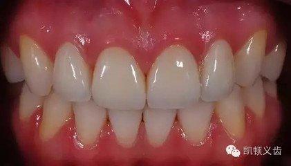 烤瓷牙和全瓷牙的优缺点是什么,钴铬合金烤瓷牙和全瓷牙优缺点