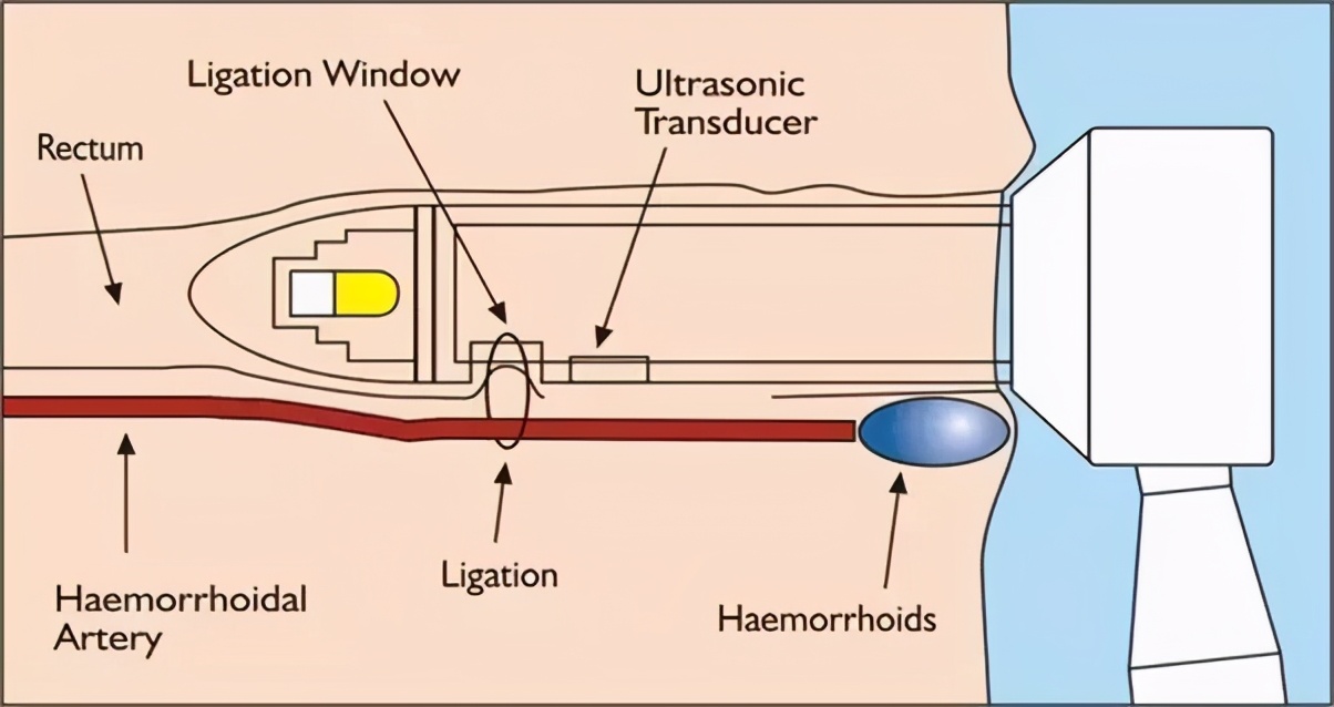 痔疮手术出院后可以不复查吗,痔疮手术后不排便可以出院吗