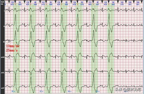 脉象动态图,脉象动图