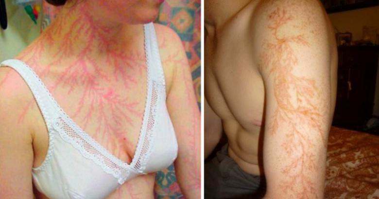 被雷劈死的人有哪些,人被雷劈是电死的还是烧死的