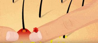 头皮毛囊炎一定要重视，不然一不小心就秃头，假发也救不了你