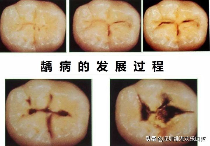 牙齿小洞你不瞅，变成大洞愁上愁