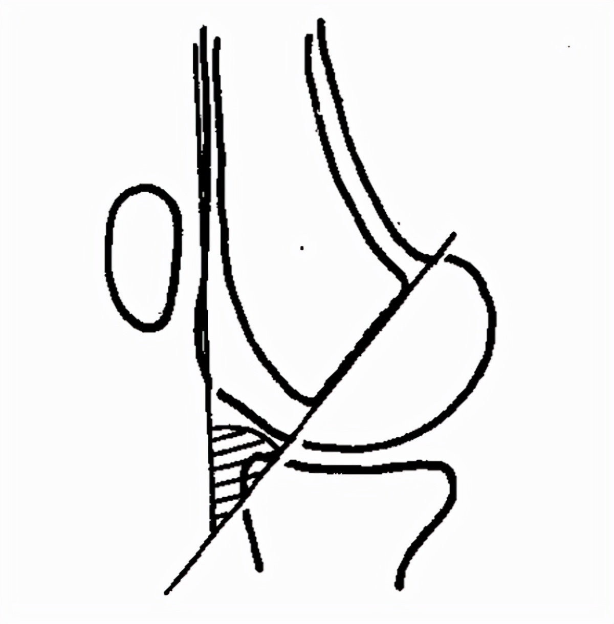 膝关节x线片可以查出啥,膝关节间隙x线测量方法