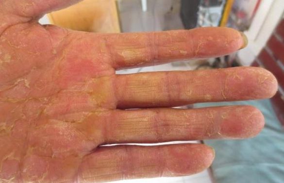 治疗脚气偏方韭菜根,辟谣脚气偏方不可信