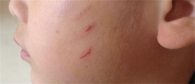 小孩外伤伤口怎么处理不留疤,深伤口用什么处理伤口不易留疤