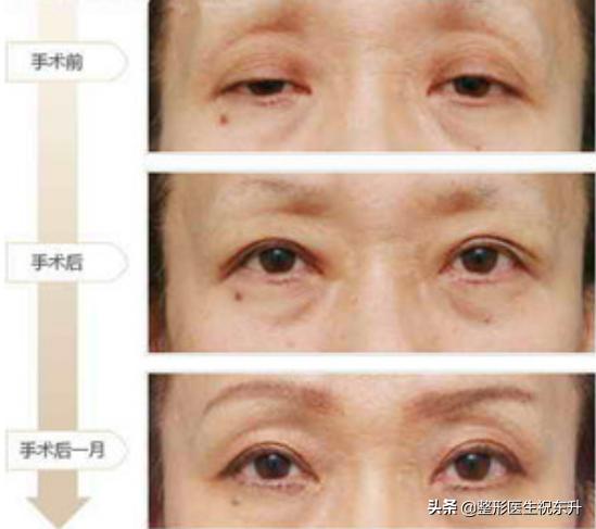 下眼皮松弛祛松皮后会回缩吗,上眼皮松弛下垂怎么办不用眼霜