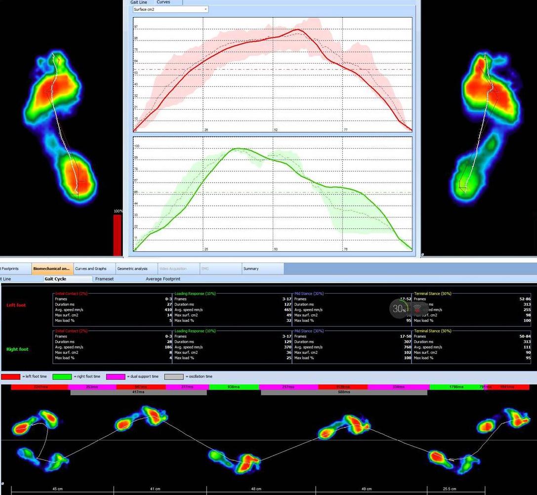 足内翻矫正鞋真的可以矫正吗,马蹄内翻足矫正鞋要穿多久