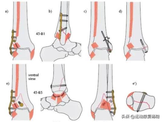 踝关节骨折术后4周康复训练视频,踝关节骨折后遗症有哪些