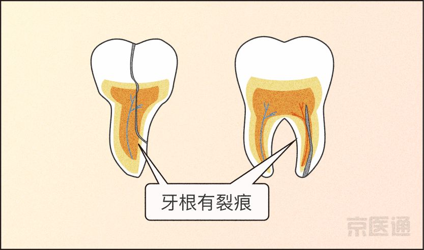 磨牙不好是真的吗,磨牙的危害与注意事项