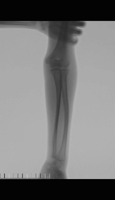 两个儿童前臂骨折争议病例之——元芳你怎么看