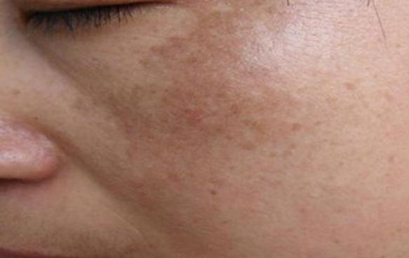 脸上长痘用手挤掉留的印子,脸上长痘怎样用粉刺针清理痘痘