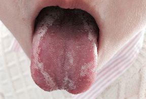 宝宝舌苔怎么辨别热还是寒,如何看宝宝舌苔来区别是否感冒