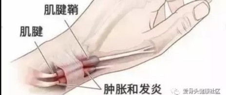 脚腱鞘炎一招搞定,腱鞘炎三个步骤轻松搞定