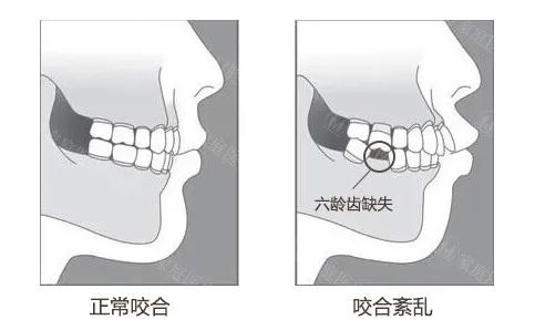 六龄齿龋坏修复全过程,六龄齿龋坏了怎么办