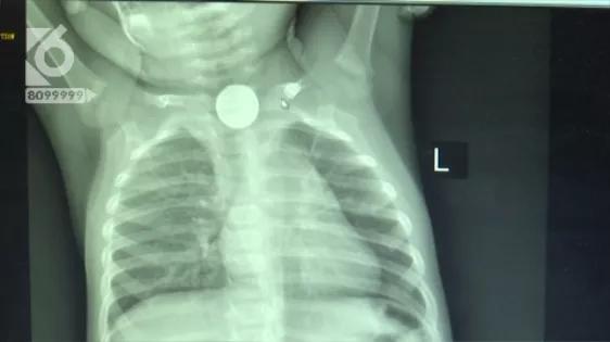 小孩误服化学物质,小孩化学物品吞肚子里怎么办