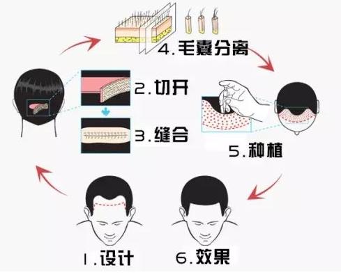 植发到底得多少钱,植发要用多少钱左右在哪里做最好