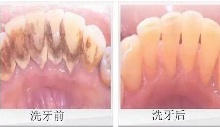 洗牙牙齿问题,医院口腔科洗牙和外面洗牙区别