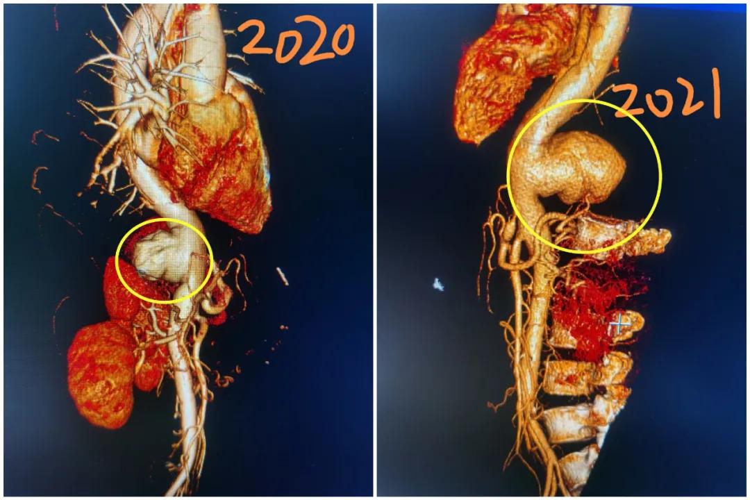小伙被感染梅毒,晚期梅毒可能造成肺部损伤吗