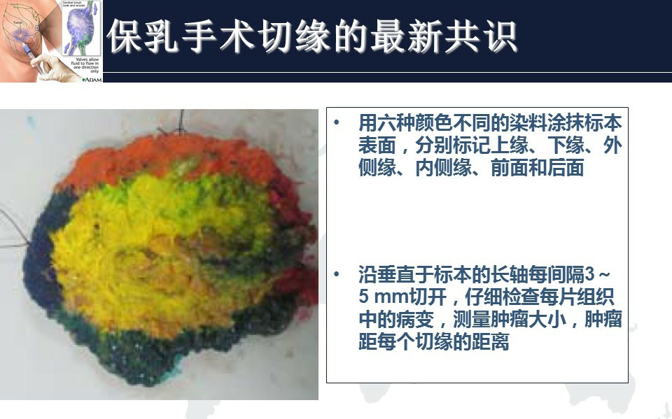 乳腺癌保乳指南,2022乳腺癌指南tnbc