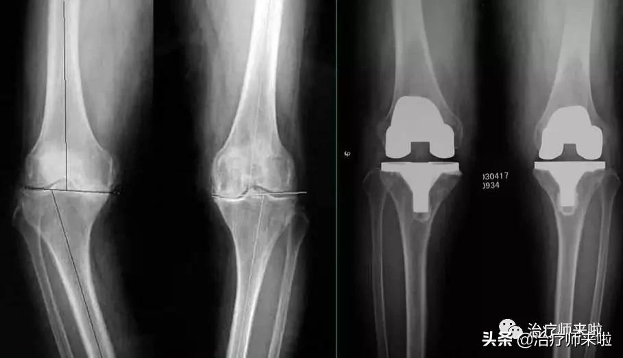 膝关节置换术后康复病历模板,做了膝关节置换术后康复视频