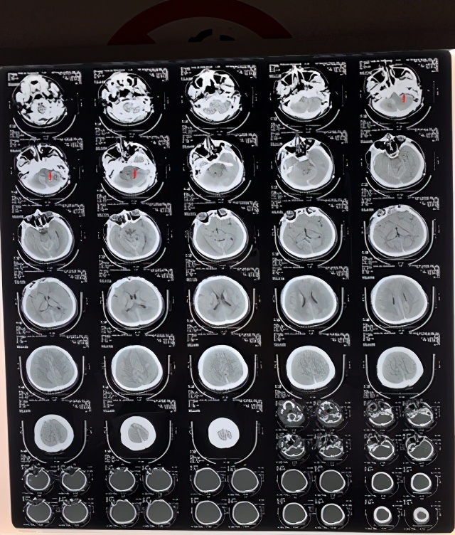 头晕耳鸣听力下降,头晕脑胀听力下降怎么回事