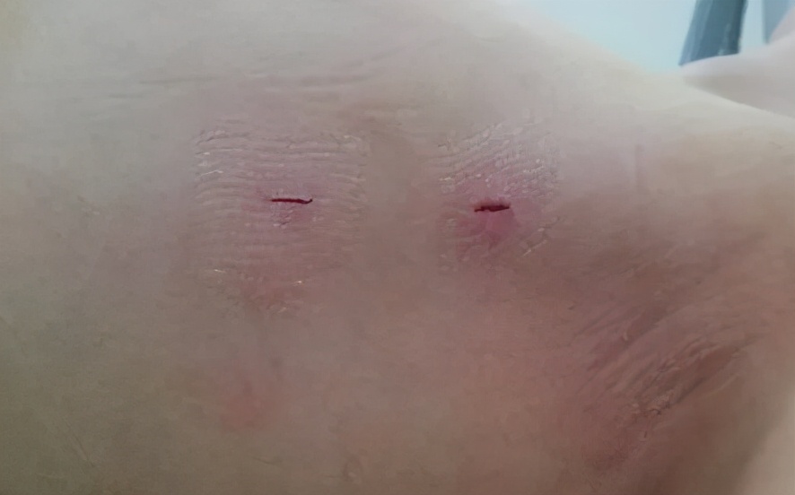 滴水的最佳解决方法,治手汗症最简单的方法