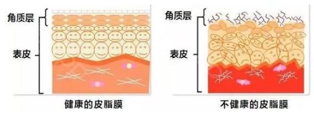 眼角皱巴巴的皱纹怎么办,眼角纹去皱最有效方法