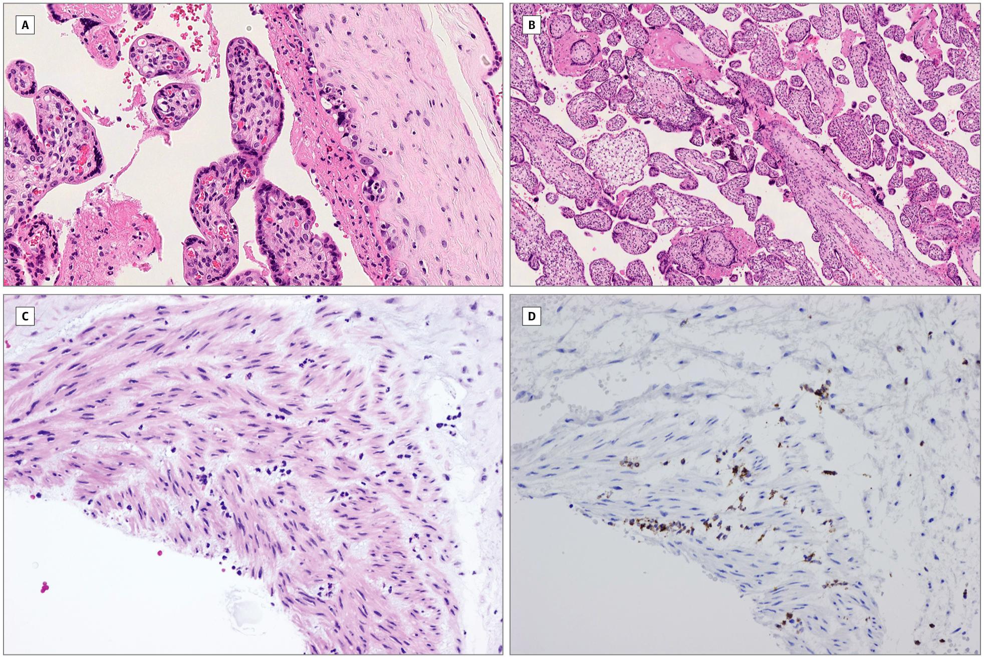 新冠病毒发病孕妇流产案例,新冠孕妇流产事件