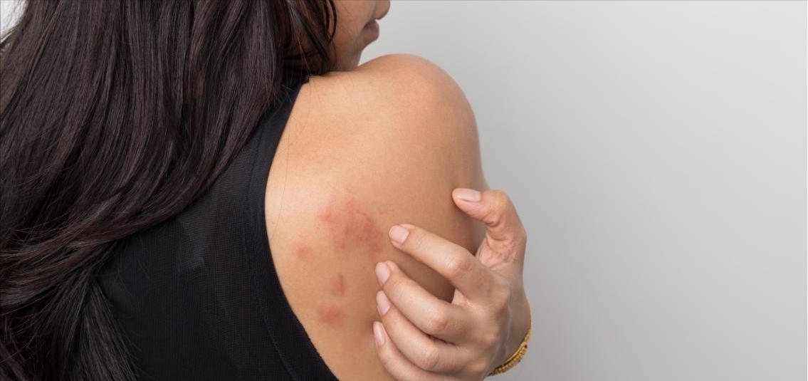 花椒煮水对荨麻疹有疗效吗,苎麻煮水喝可以治荨麻疹吗