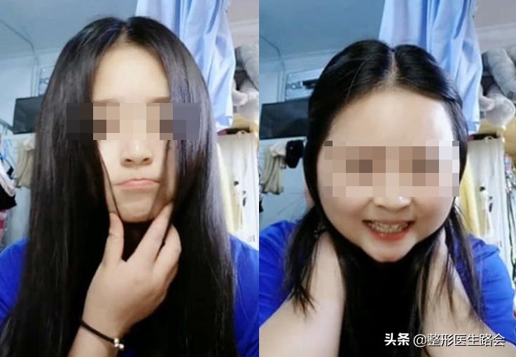 下颌角整形│对不起,你的脸让我的心好“方”