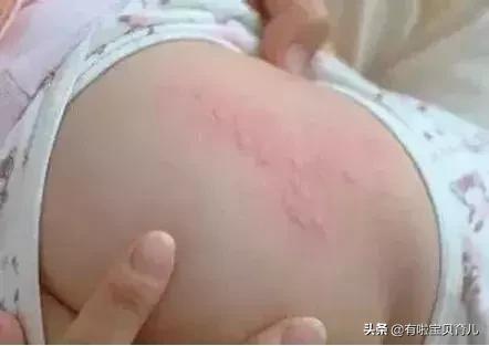 麻疹样幼儿急疹,麻疹风疹幼儿急疹的鉴别点有哪些